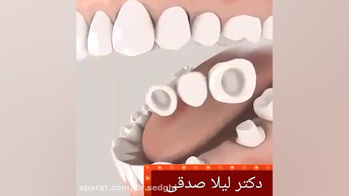 کاندید روکش دندان چه کسانی هستند ؟ برداشتن خال گوشتی