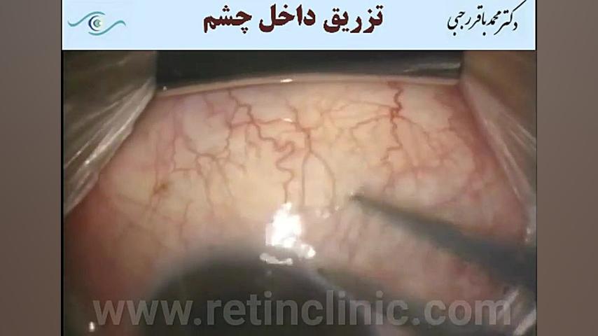 فیلم تزریق در چشم دکتر محمد باقر رجبی -فوق تخصص شبکیه و لیزر