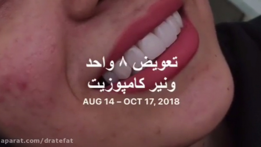 ونیر کامپوزیت اصفهان -متخصص ترمیمی زیبایی اصفهان دکتر محمد عاطفت متخصص ترمیمی و زیبایی اصفهان