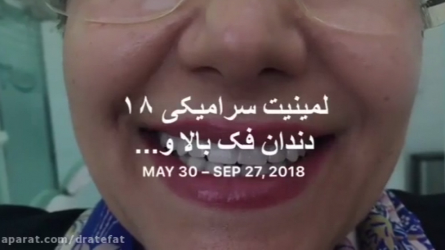 لمینیت سرامیکی و اصلاح طرح لبخند اصفهان-دکتر محمد عاطفت دکتر محمد عاطفت متخصص ترمیمی و زیبایی اصفهان