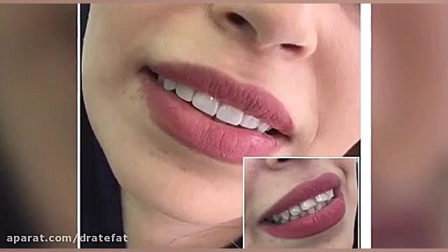اصلاح طرح لبخند اصفهان ،متخصص دندانپزشکی ترمیمی زیبایی اصفهان دکتر محمد عاطفت متخصص ترمیمی و زیبایی اصفهان