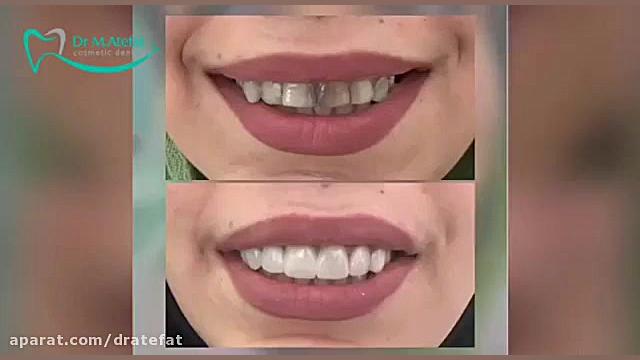 اصلاح طرح لبخند اصفهان،دکتر محمد عاطفت متخصص ترمیمی اصفهان دکتر محمد عاطفت متخصص ترمیمی و زیبایی اصفهان
