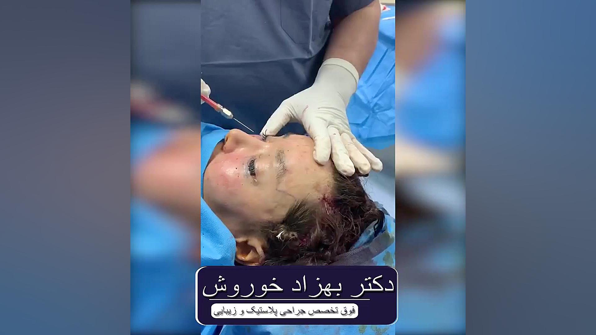 تزریق چربی زیر چشم سیستم نانواینژکتور