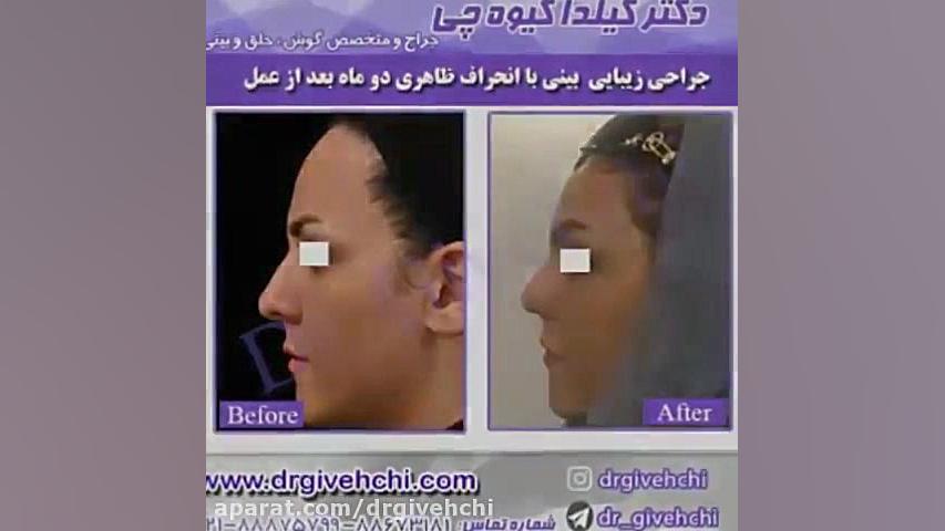 نمونه کار جراحی زیبایی گوش ربات میکرونانو جراحی