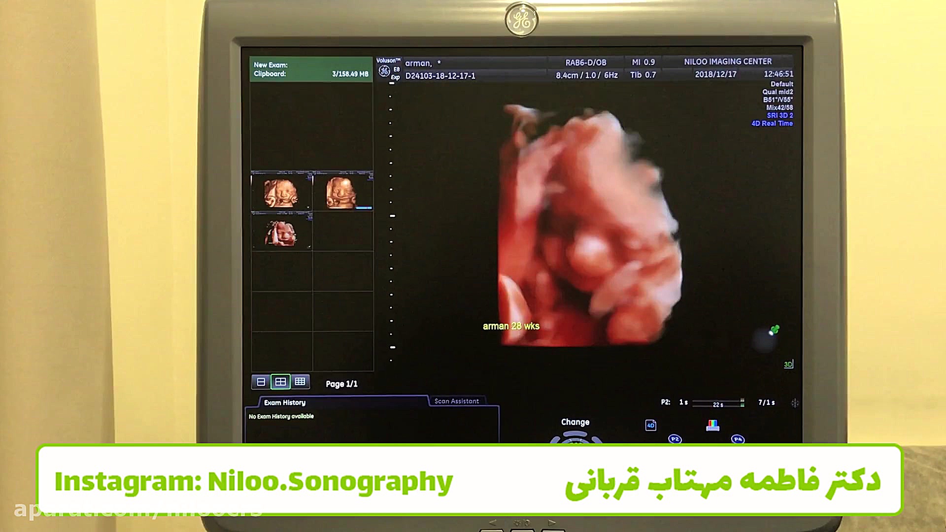 از بند ناف نترسیم سونوگرافی نیلو دکتر فاطمه مهتاب قربانی