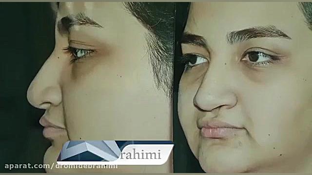 جراحی بینی لب شکری توسط دکتر امید ابراهیمی بهترین جراح بینی دکتر امید ابراهیمی