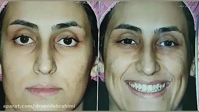 جراحی بینی استخوانی قوز دار، توسط دکتر امید ابراهیمی دکتر امید ابراهیمی