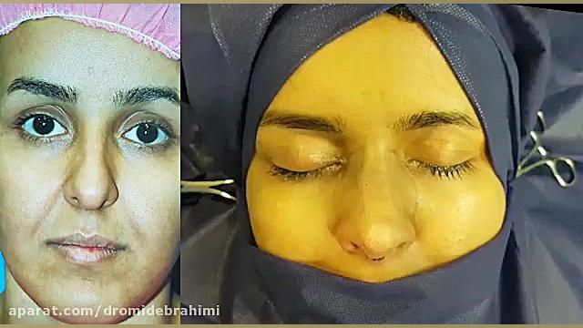 جراحی بینی استخوانی قوز دار، توسط دکتر امید ابراهیمی بهترین جراح بینی دکتر امید ابراهیمی