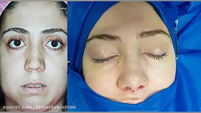 جراحی ترمیمی بینی گوشتی، توسط دکتر امید ابراهیمی بهترین جراح بینی دکتر امید ابراهیمی
