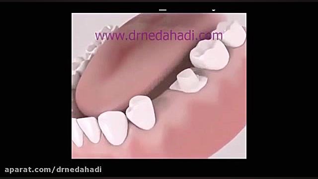 بریچ دندان | دکتر ندا هادی دندانپزشک زیبایی و ترمیمی دکتر ندا هادی-دندانپزشک زیبایی