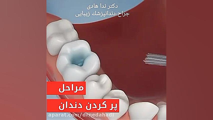 پر کردن دندان ها | دکتر ندا هادی دندانپزشک زیبایی و ترمیمی دکتر ندا هادی-دندانپزشک زیبایی