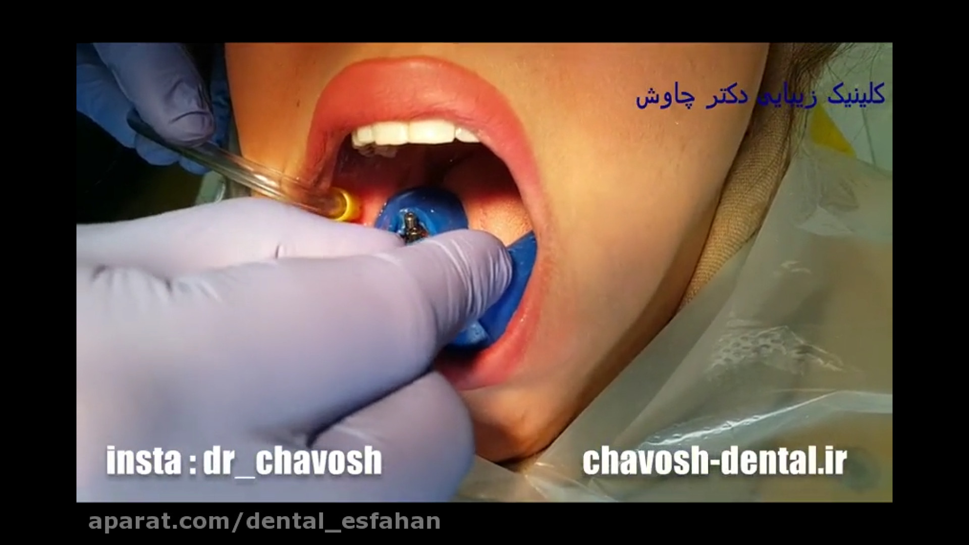 فیلم قالب گیری ایمپلنت دندان درمان ریزش مو