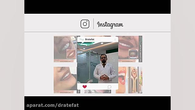 بهترین متخصص زیبایی دندان در اصفهان ، ونیر کامپوزیتی و سرامیکی دکتر محمد عاطفت متخصص ترمیمی و زیبایی اصفهان