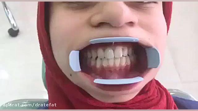 بهترین متخصص زیبایی دندان،اصلاح طرح لبخند ،ونیر کامپوزیتی و سرامیکی در اصفهان دکتر محمد عاطفت متخصص ترمیمی و زیبایی اصفهان