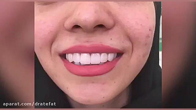 تعویض 8 واحد ونیر کامپوزیتی قدیمی و اصلاح طرح لبخند ،اصفهان دکتر محمد عاطفت متخصص ترمیمی و زیبایی اصفهان