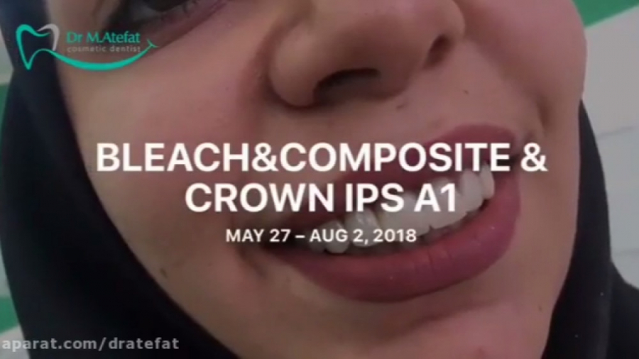 بهترین متخصص دندانپزشکی زیبایی اصفهان ونیر کامپوزیت و اصلاح طرح لبخند دکتر محمد عاطفت متخصص ترمیمی و زیبایی اصفهان