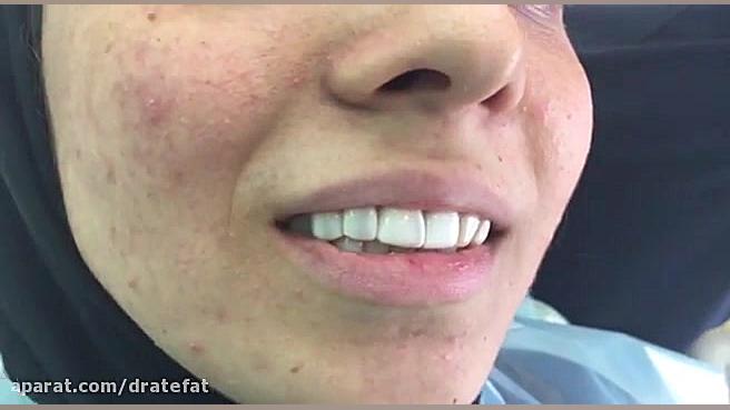 بهترین متخصص دندانپزشکی زیبایی اصفهان درمان کامپوزیت دندان دکتر محمد عاطفت متخصص ترمیمی و زیبایی اصفهان