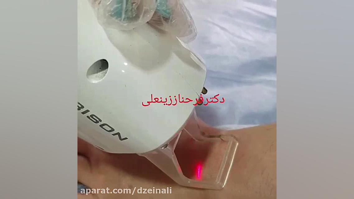 لیزر جوانسازی و رفع لک پشت دست ها دکتر فرحناز زینعلی - متخصص پوست، مو، زیبایی زنجان