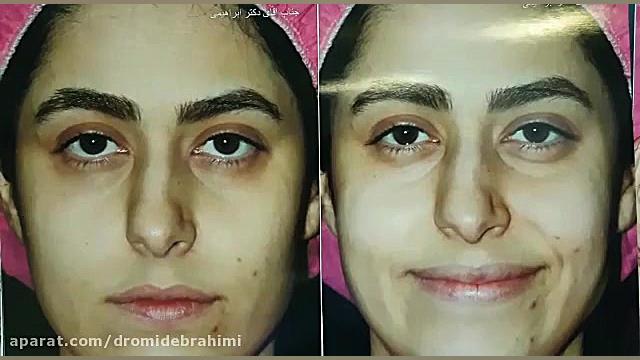 جراحی انحراف بینی توسط دکتر امید ابراهیمی بهترین جراح بینی دکتر امید ابراهیمی