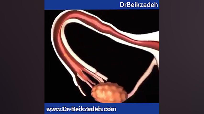 لقاح و جایگزینی جنین دکتر مژگان بیک زاده ( جراح و متخصص زنان و زایمان)