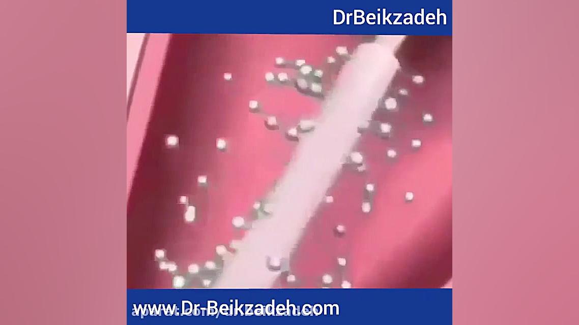 قرار دادن دستگاه در رحم دکتر مژگان بیک زاده ( جراح و متخصص زنان و زایمان)