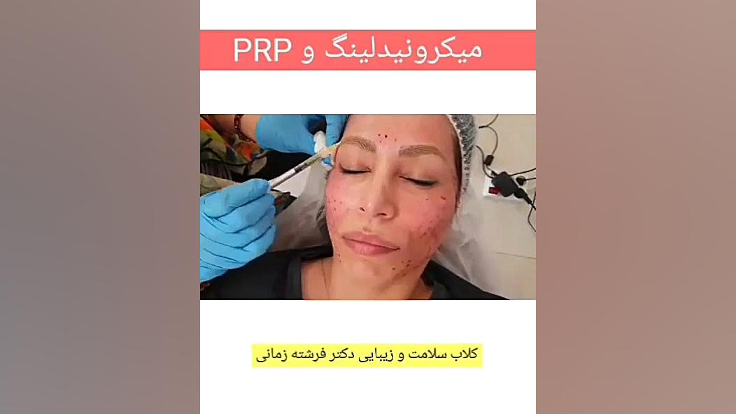 پی آر پی و میکرونیدلینگ آکنه