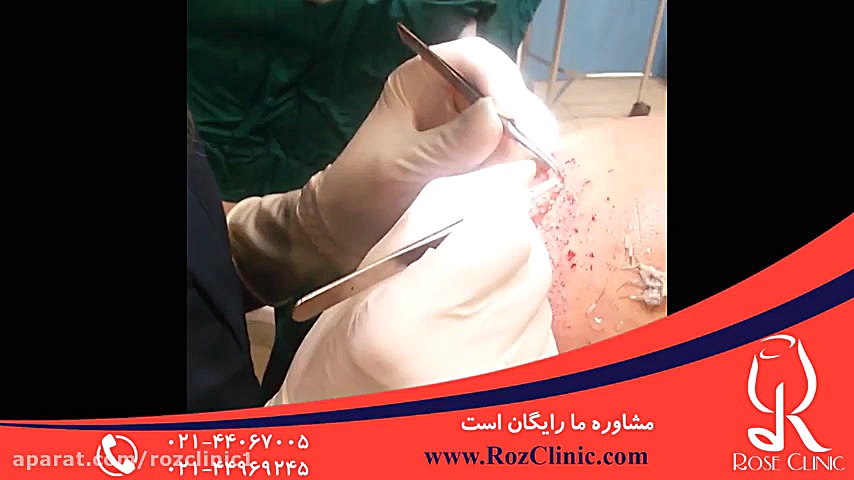 کاشت مو | فیلم کاشت مو | کلینیک پوست و مو رز | شماره18 علامت لاسگ