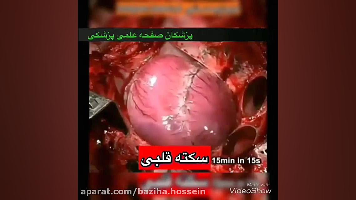 سکته قلبی رفع چین و چروک