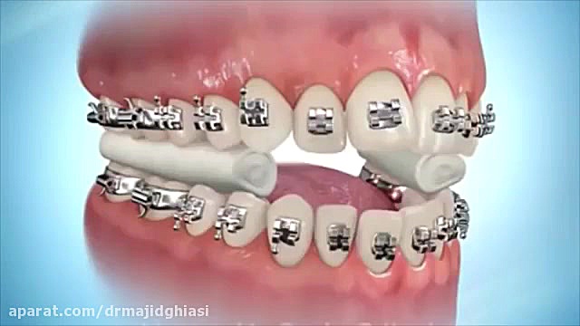 آموزش مراحل ارتودنسی دندان-دکترمجیدقیاسی جراح ودندانپزشک دکترمجیدقیاسی
