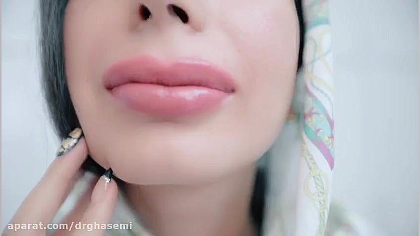 فیلم تزریق ژل به لب دکتر علی قاسمی(پوست ، مو ، زیبایی )