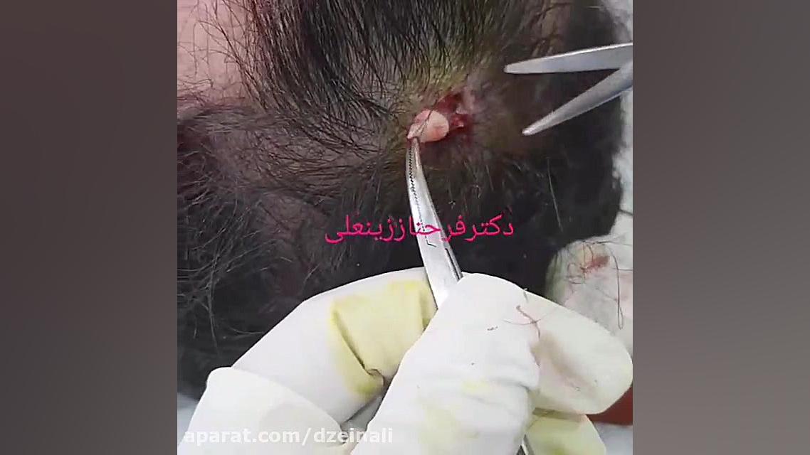 جراحی کیست پیلار کف سر دکتر فرحناز زینعلی - متخصص پوست، مو، زیبایی زنجان