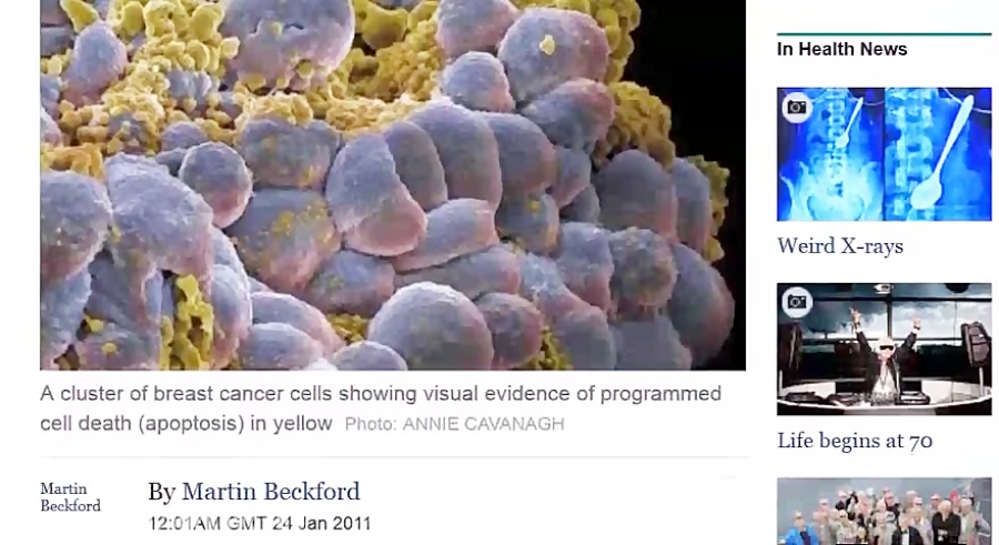 تأثیر مصرف الکل و تغذیهٔ بد بر میزان سرطان سینه در انگلیس