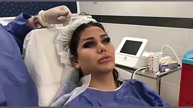 لیفت ابرو با نخ سیلوئیت امریکایی زوترلینیب