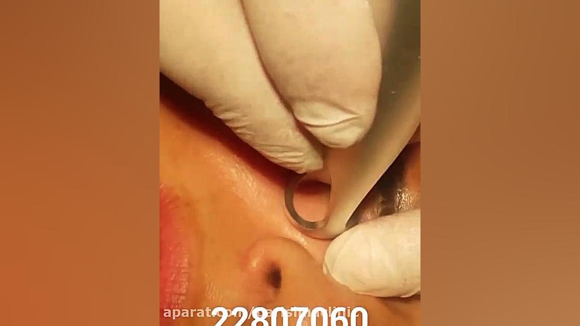 برداشت خال - کلینیک زیبایی پری سیما - 22807060 کاردیومگالی