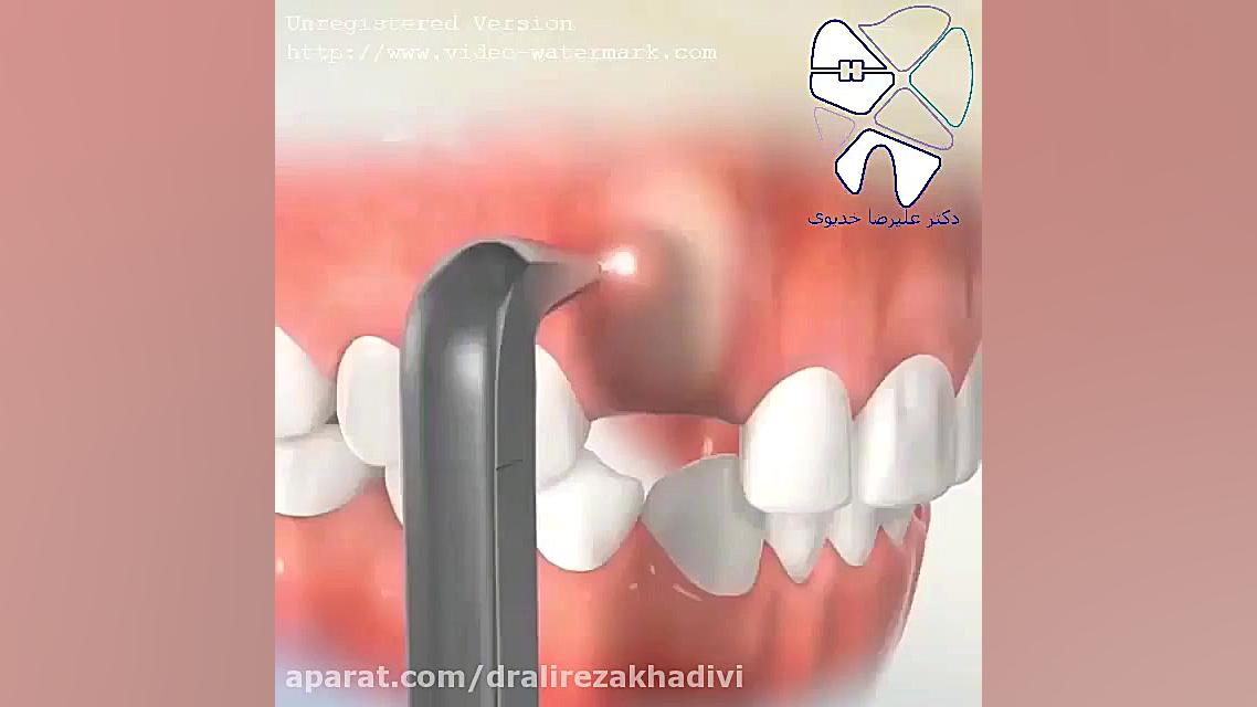 درمان دندان نهفته توسط جراحی وارتودنسی دکتر علیرضا خدیوی