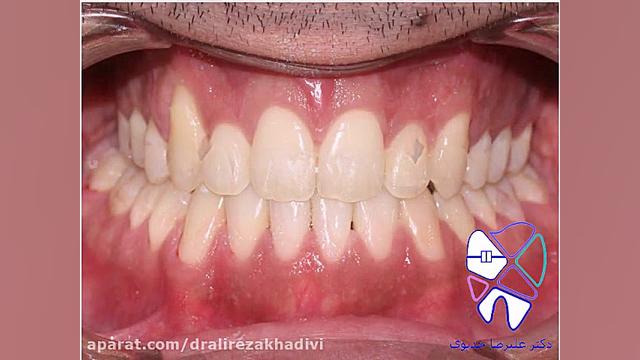 اصلاح بیرون زدی فک پایین دکتر علیرضا خدیوی