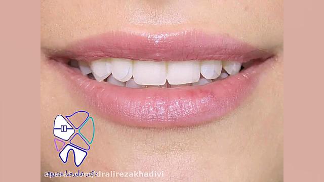 اصلاح طرح لبخند هالوسیناتوری بویایی