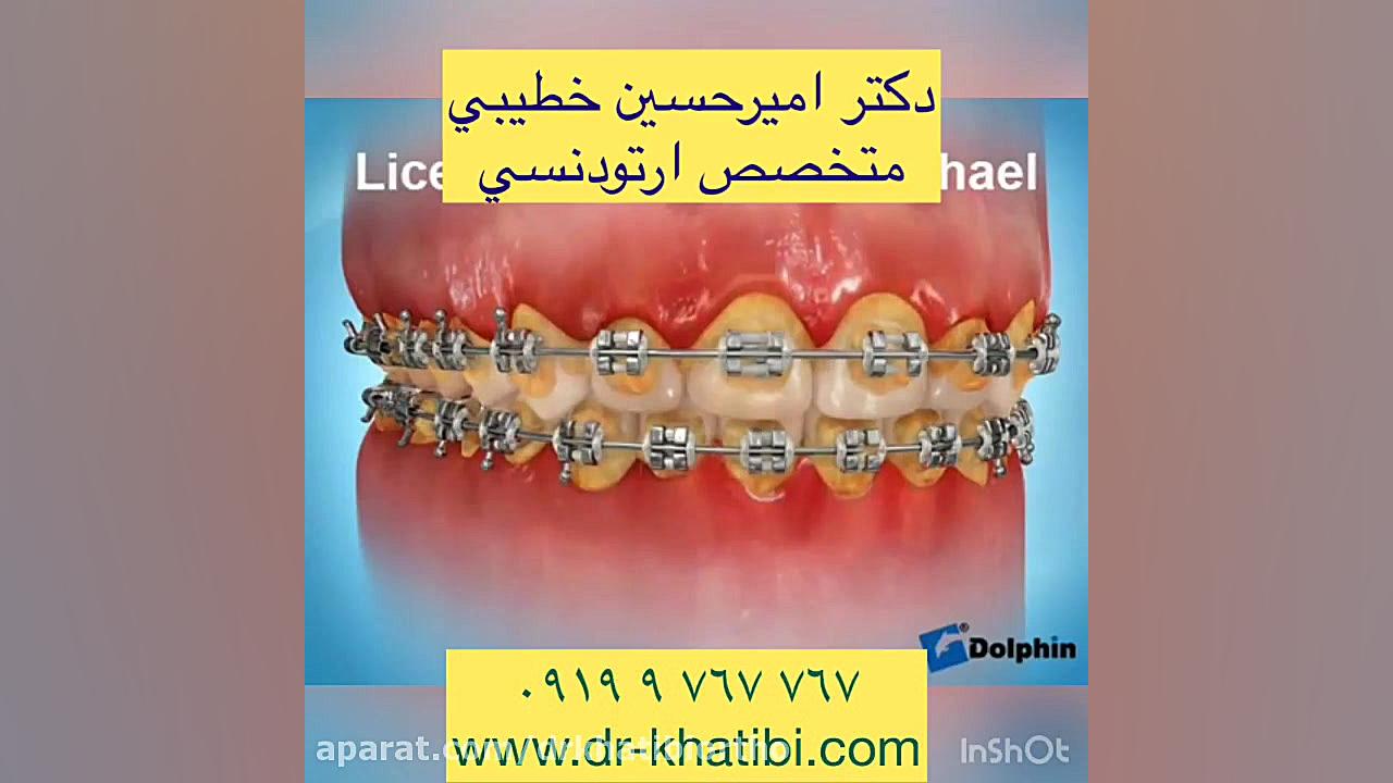عوارض عدم رعايت بهداشت در ارتودنسي دکتر امیرحسین خطیبی