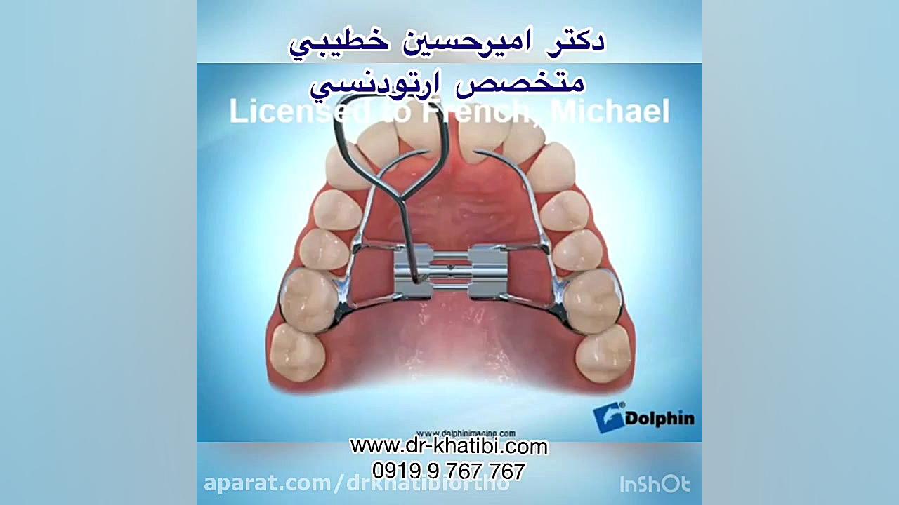 دستگاه گسترش دهنده كام دکتر امیرحسین خطیبی