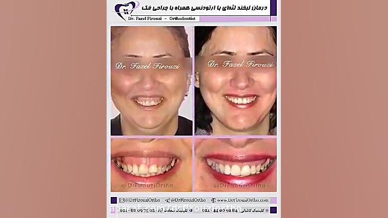 درمان لبخند لثه ای | دکتر فیروزی علامت برودزینسکی