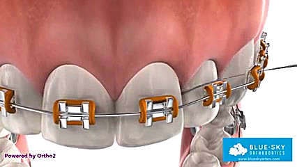 ارتودنسی اهواز _ دکتر عینی _ نحوه صحیح استفاده از نخ دندان دکتر ابراهیم عینی