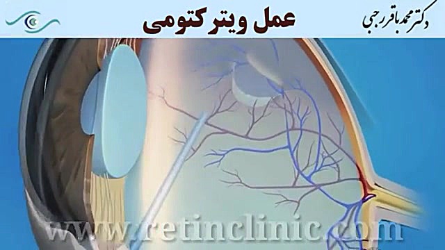 عمل ویترکتومی دکتر محمد باقر رجبی -فوق تخصص شبکیه و لیزر