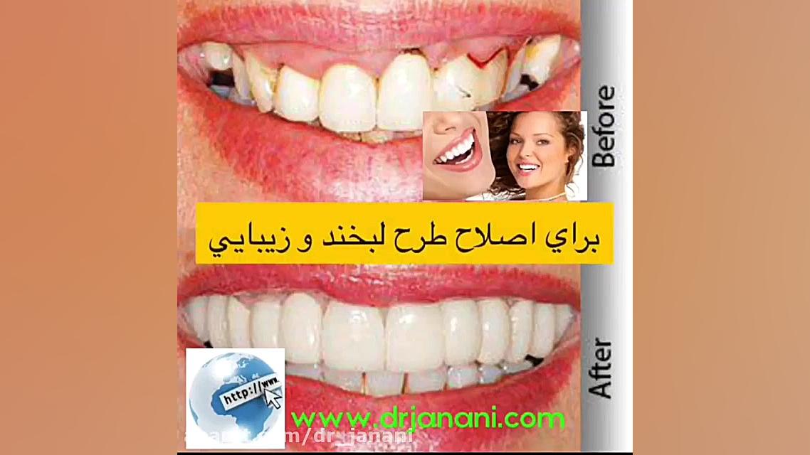 اهمیت روکش دندان RNA Interference Assay