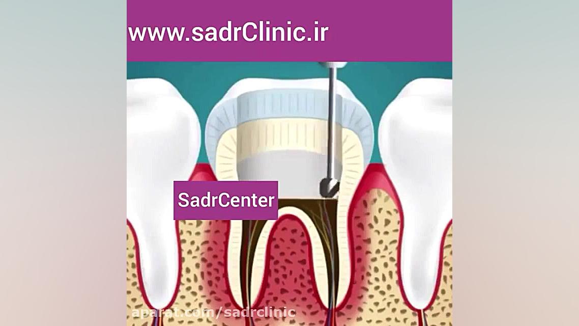 عصب کشی و ترمیم دندان !!!! نوروجراحی فانکشنال