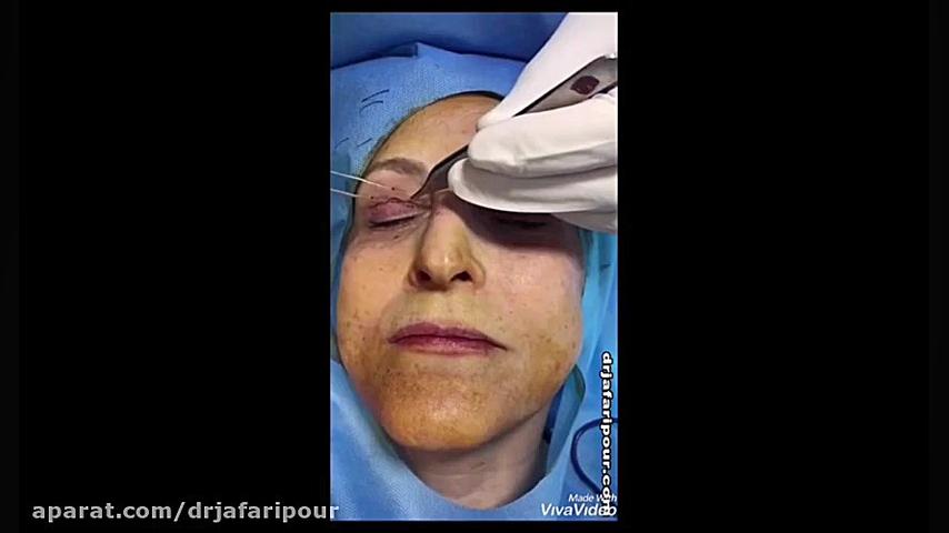 نحوه ی علامت گذاری جراحی زیبایی پلک دکتر مسعود جعفری پور