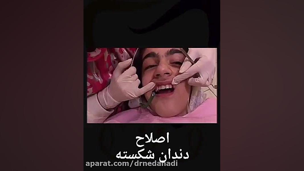 اصلاح دندان شکسته | دکتر ندا هادی دنداپزشک ترمیمی دکتر ندا هادی-دندانپزشک زیبایی