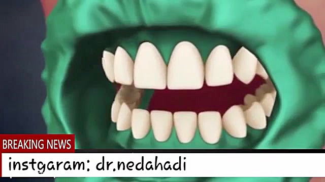انیمیشن بلیچینگ و سفید کردن دندان دکتر ندا هادی-دندانپزشک زیبایی