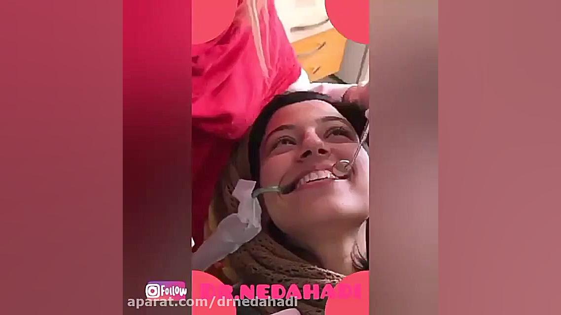 ترمیم دو دندان پیش میانی بیمار با لمینت کامپوزیت (مدل خرگوشی) دکتر ندا هادی-دندانپزشک زیبایی
