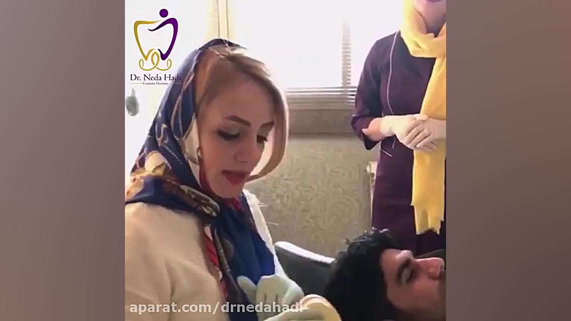 بازسازی دندان های شکسته به وسیله روکش دکتر ندا هادی-دندانپزشک زیبایی