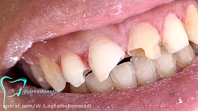 کامپوزیت ونیر جراحی فک